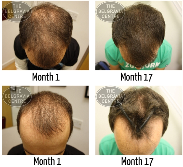 Different-Levels-of-Hair-Regrowth-Results-from-Hair-Loss-Treatment-for-Genetic-Hair-Loss-at-The-Belgravia-Centre