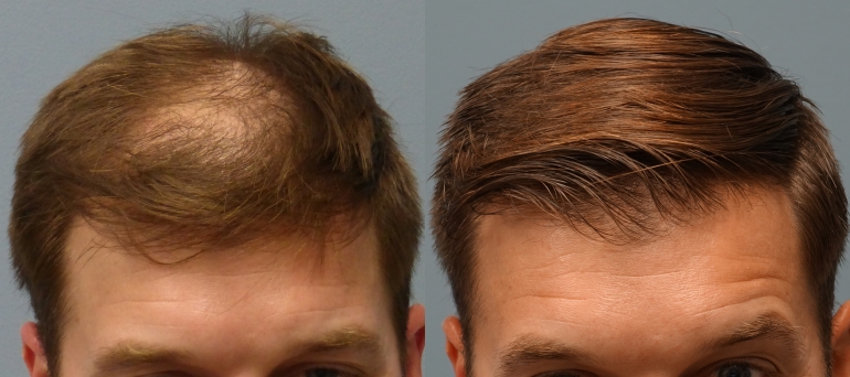 Before-and-After-Hair-Transplant-Elasticity-Soft-Tight-structure-Black-hair