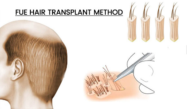 FUE-Hair-Transplantation-treatment-Hair-growth-Glamfields