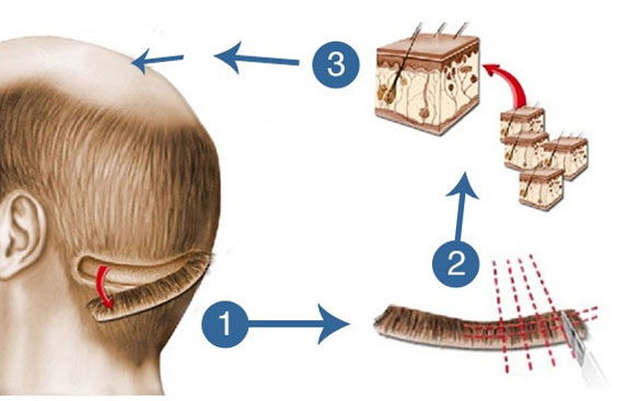 FUT-Hair-Transplantation-treatment-Hair-growth-Glamfields