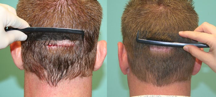 fut-hair- transplant-of-Precautions-on-the-day-of-hair-transplant