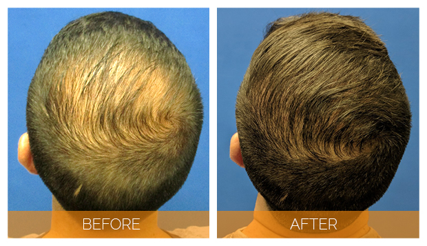Hair-Doctor-Male-Hair-Transplant-Hair-Treatment-Glamfields-Blog