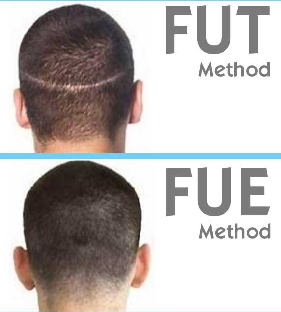 whats-the-difference-between-fut-with-fue-about-hair-transplant